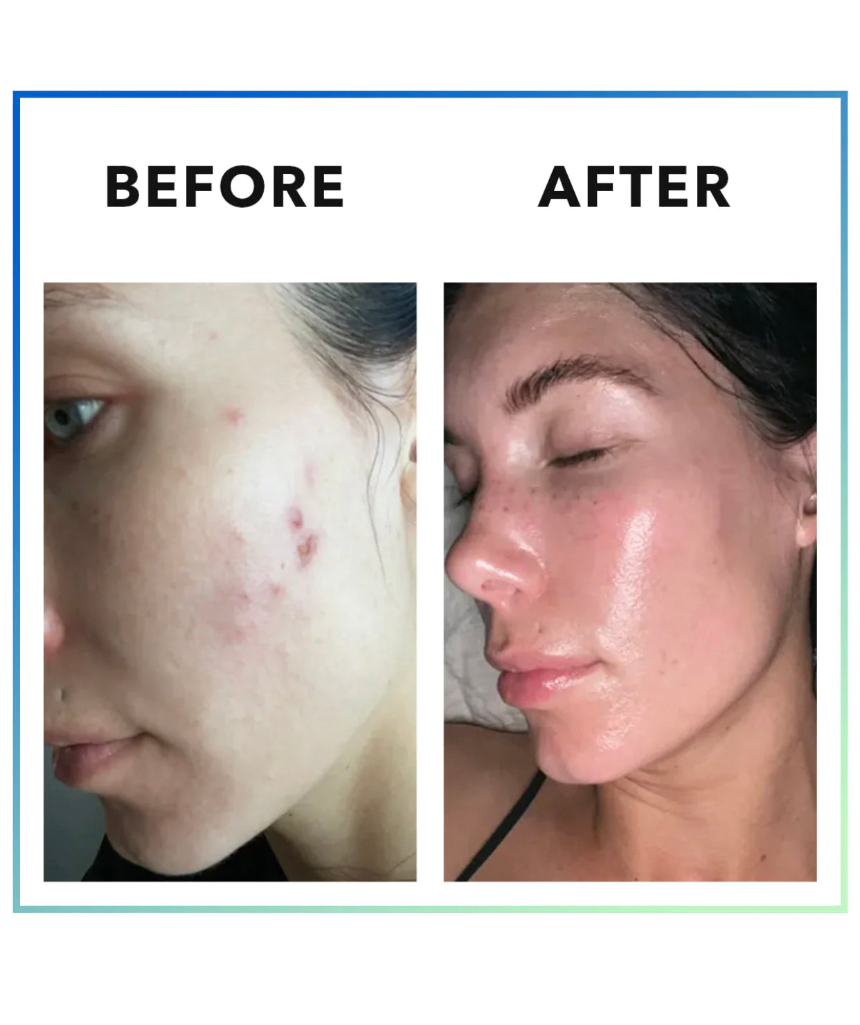 CLEAR STEM MINDBODYSKIN® Hormonal Acne Supplement