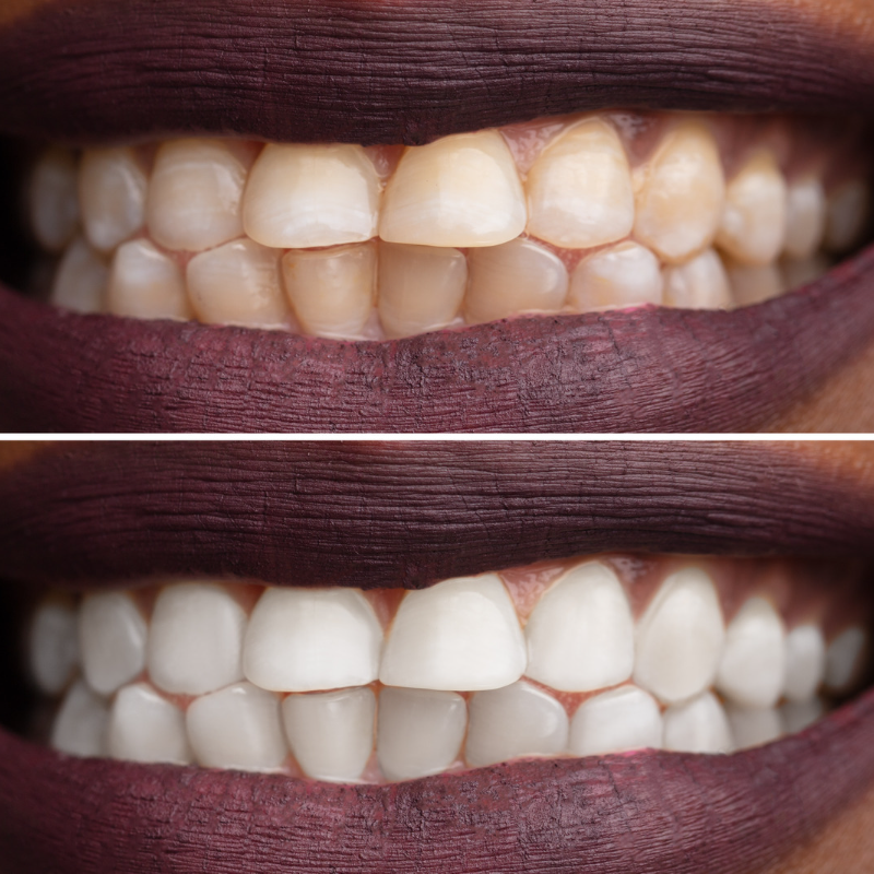 Teeth Whitenings
