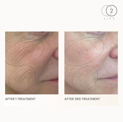 CO2 Lift Pro Carboxytherapy at Home Treatment