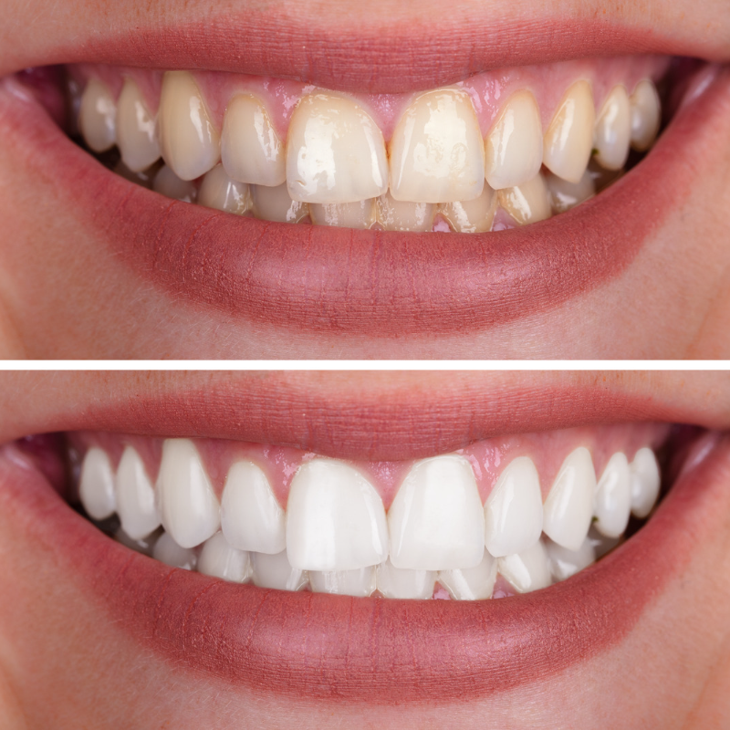 Teeth Whitenings