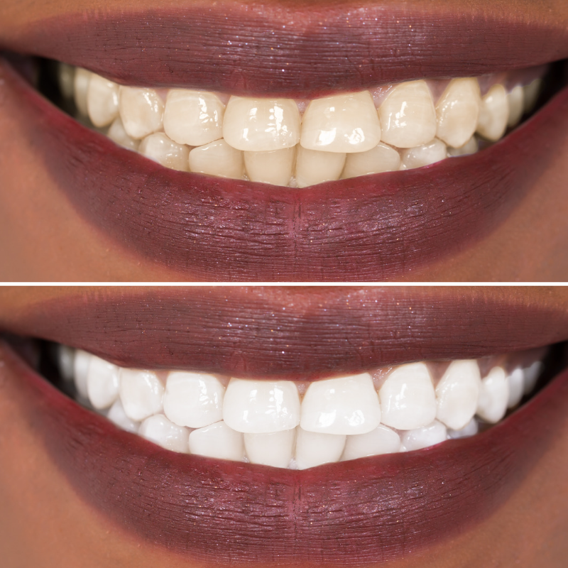 Teeth Whitenings