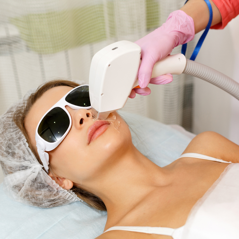 Upper Lip & Chin Laser Hair Removal - Women