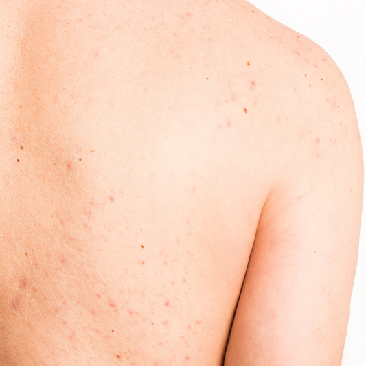 Back Acne Laser