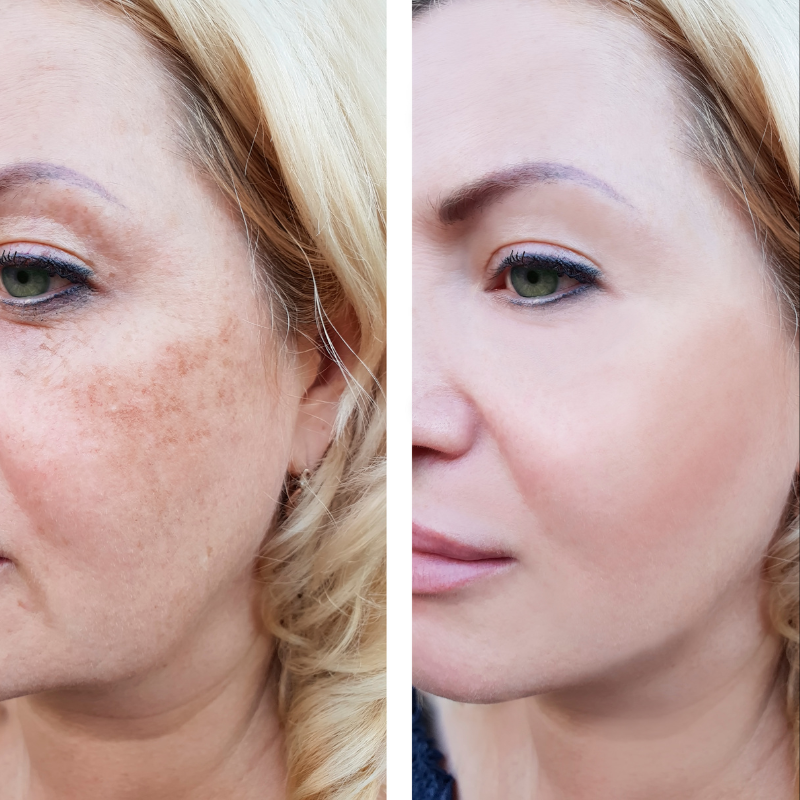 Cheeks Broken Capillaries Laser Treatment