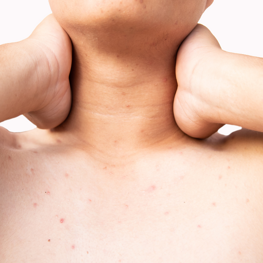 Chest Acne Laser