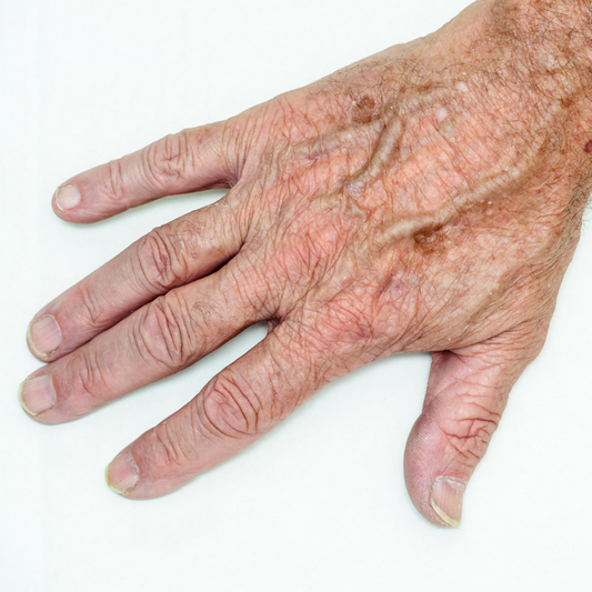 Hands Sun Spots Laser Treatment