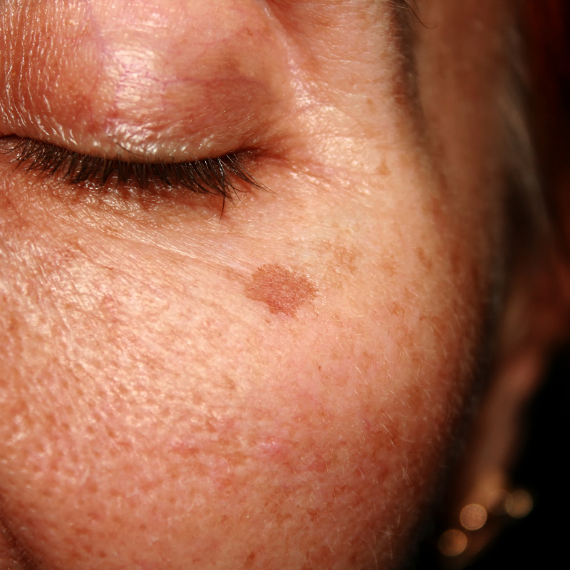 Individual Sun Spots Laser Treatment