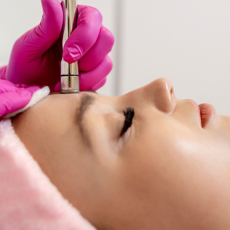 Microdermabrasion (Face)