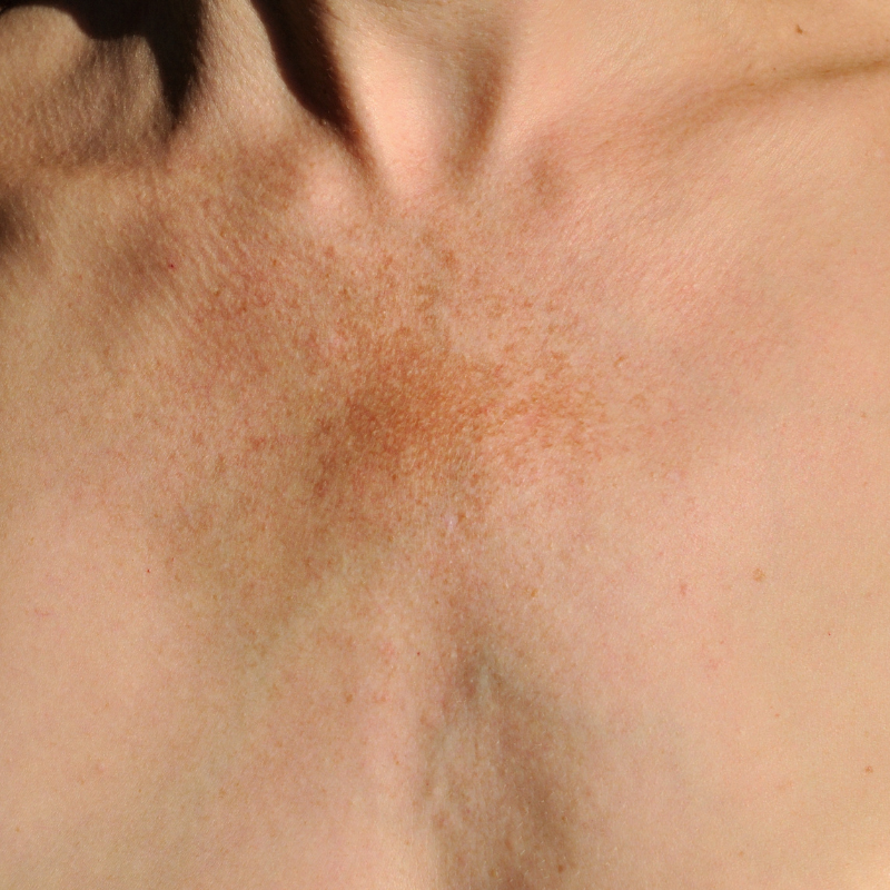 Chest Broken Capillaries Laser Treatment