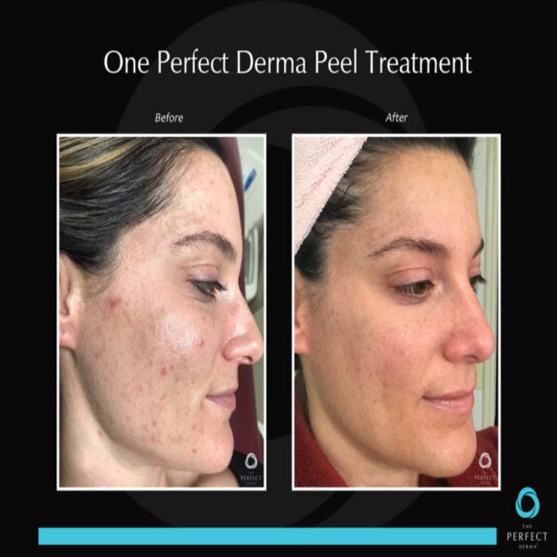 The Perfect Derma™ Peel