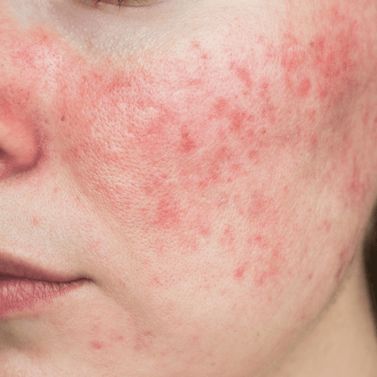 Cheeks Rosacea Laser Treatment