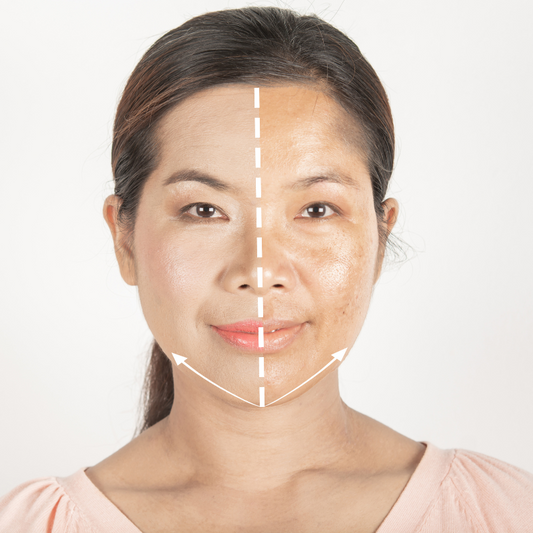 Full Face Sun Spots Laser Treatment