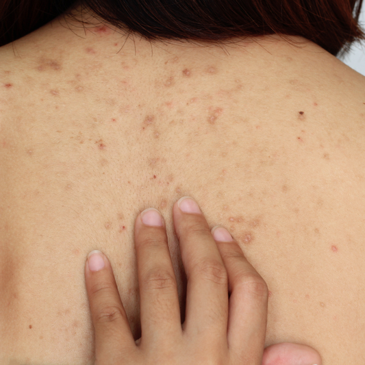 Upper Shoulder Acne Laser
